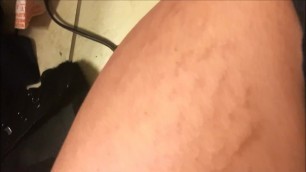 Chubby White Girl Shows off Dark Red and Purple Stretch Marks Scars Thighs